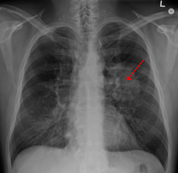 A new lung cancer treatment has seen some success Photo Courtesy of Dr. James Heilman